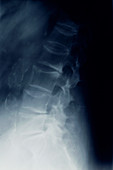 Tinted x-ray of osteoporosis in spine