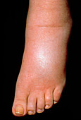 A swollen foot in a case of pitting Oedema