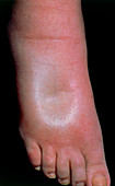 A swollen foot in a case of pitting oedema