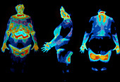 Three thermograms of an obese woman