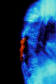 X-ray of osteoporosis of the thoracic spine