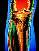 F/col CT scan of osteonecrosis of tibia bone