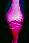 Coloured X-ray of femur affected by osteomyelitis