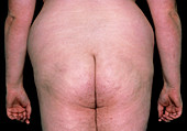 Back view of an obese man's hips and buttocks