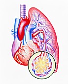Artwork of lung oedema in heart failure