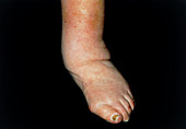 Deformed ankle and foot with oedema