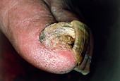 Onychogryphosis or abnormal growth of the toenail