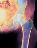 Coloured X-ray of hip fracture due to osteoporosis