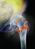 Coloured X-ray of femur fracture in osteo