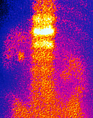 Coloured gamma scan of osteoporosis in vertebra