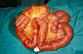 Obstructed bowel