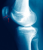 Knee disease