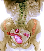 Spinal osteoporosis,X-ray