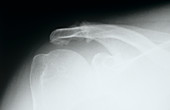 Disintegrating bone,X-ray