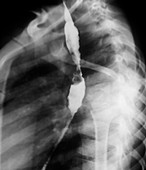 Oesophageal stricture,X-ray