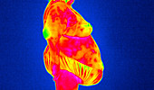 Obese woman,thermogram