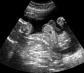 Foetus with oedema,ultrasound scan