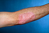 Ordinary photo showing Psoriasis on elbow