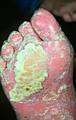 Psoriasis affecting the sole of the foot