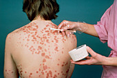 Lassar's paste applied for treatment of psoriasis