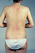 Patches of psoriasis on a young woman's back