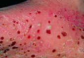 Close-up of pustular psoriasis on foot