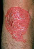 Psoriasis on the skin of the knee