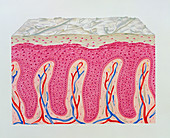 Artwork of psoriasis of skin epidermis in section