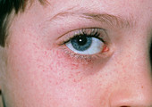 Purpura rash on child's face after vomiting