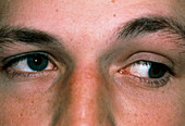 Squint caused by congenital cranial nerve palsy