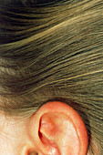 Nits (head louse eggs) in human hair