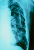 X-ray of lung affected by pneumothorax & emphysema