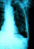 X-ray of chest drain used to relieve pneumothorax