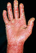 Psoriasis on the hand of a 63 year old man
