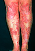 Psoriasis on the leg of a 34 year old woman