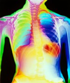 Coloured chest X-ray showing pneumonia
