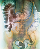 Coloured X-ray of the abdomen showing proctitis