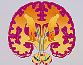 Artwork of brain depicting Parkinson's disease