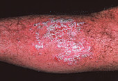 Psoriasis