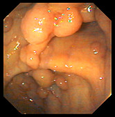 Polyps in the colon