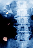 Porocephaliasis infection,X-ray