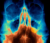 Sinus polyp,facial X-ray