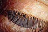 Lice on eyelashes