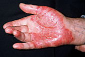 Psoriasis