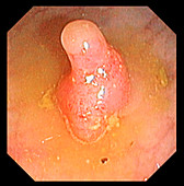 Colonic polyp