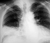 Pneumonia,X-ray