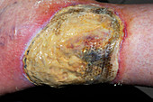 Pyoderma ulcer on a diabetic patient