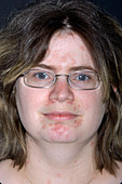 Psoriasis on a woman's face
