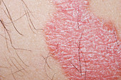 Psoriasis on a man's body
