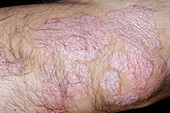 Psoriasis on a man's elbow